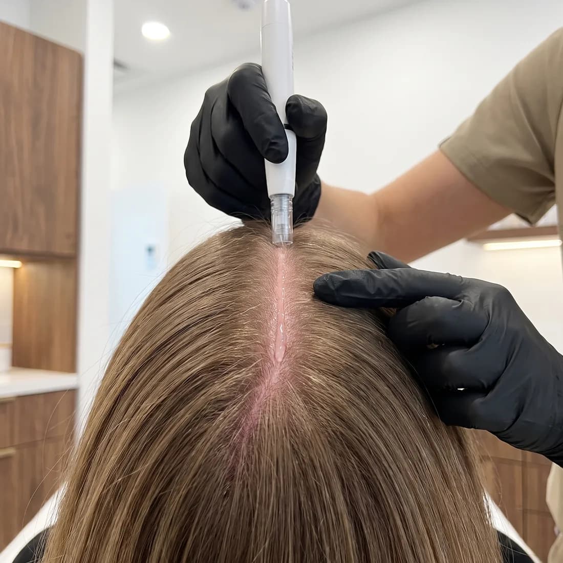 The microneedling pen tip on a scalp parting, serum visible along the line