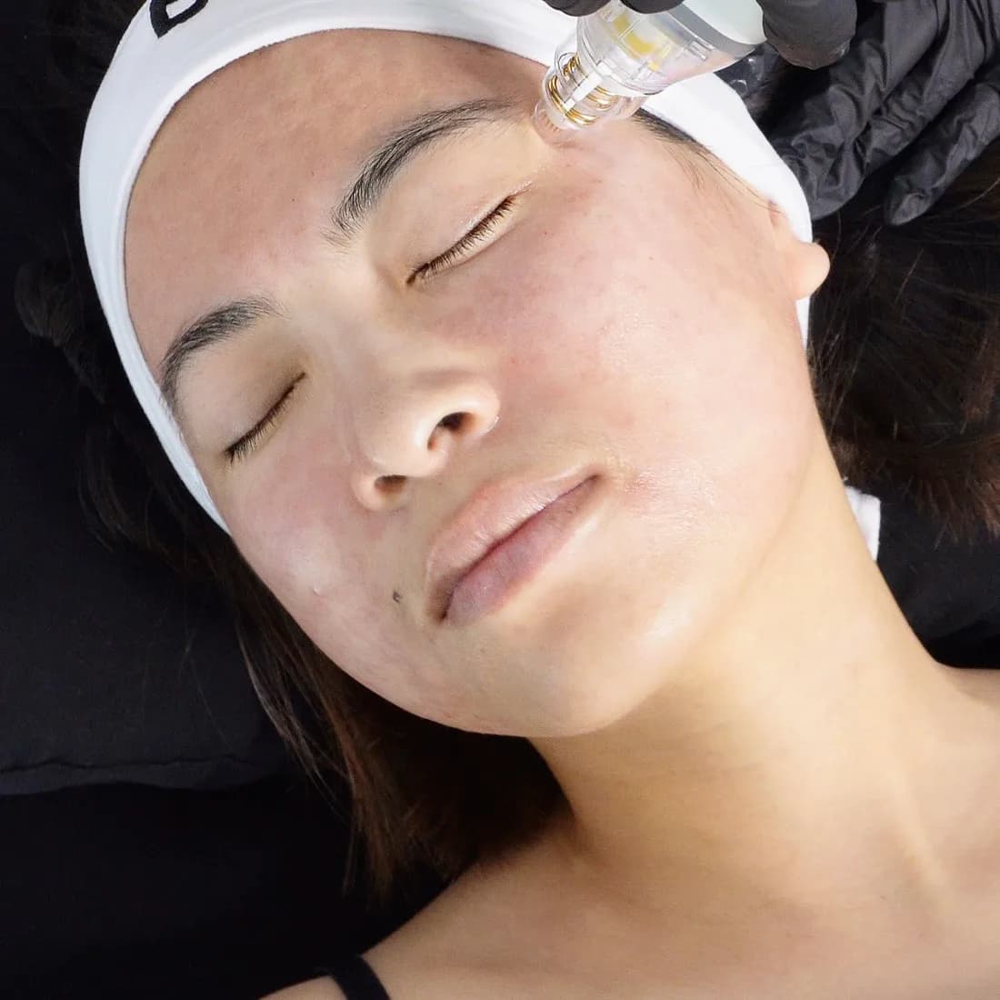 A microneedling pen moving across a client's cheek, Béa headband on