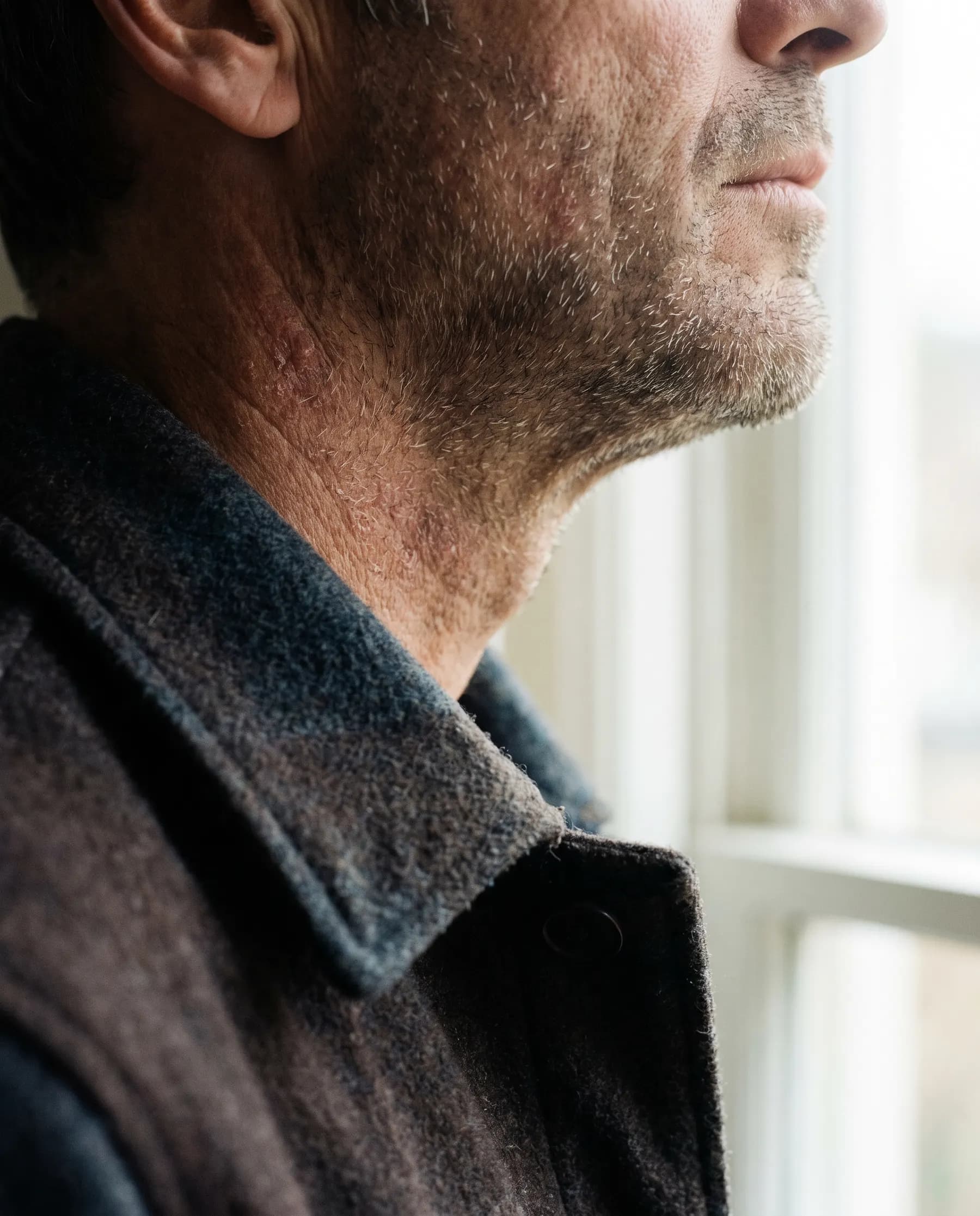 Machoire et cou d'un homme, peau irritee par le rasage